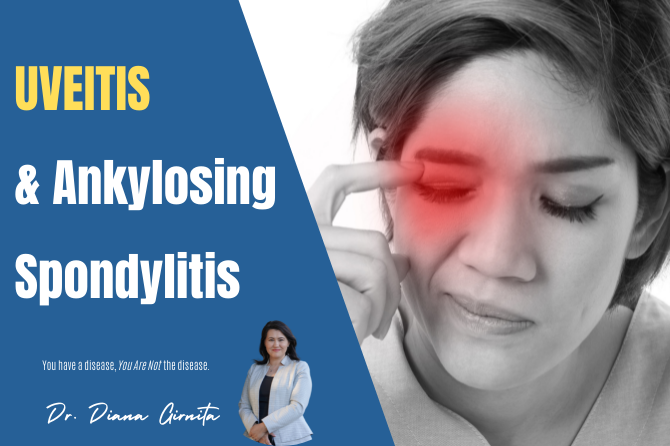 Uveitis and Ankylosing Spondylitis