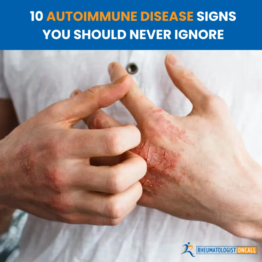 autoimmune disease signs