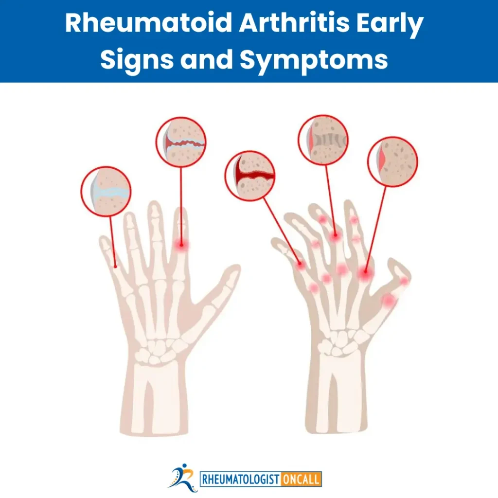 rheumatoid arthritis early signs and symptoms